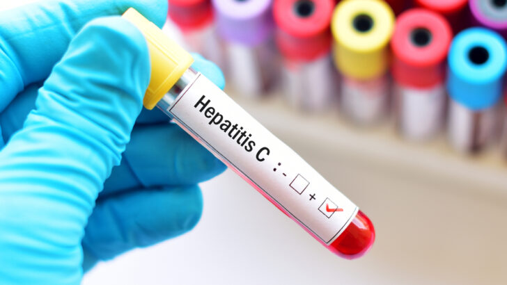Hepatit C Nedir, Nasıl Bulaşır? Tiedavisi Nasıl Yapılır?